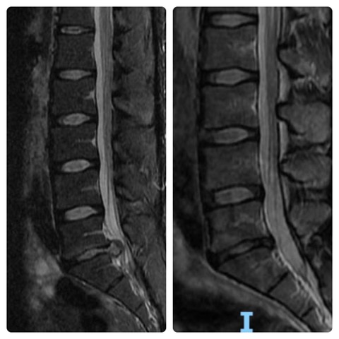 hernia discal radiografia