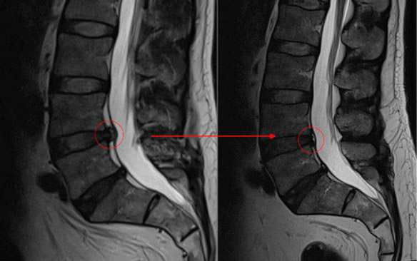 hernia con flecha